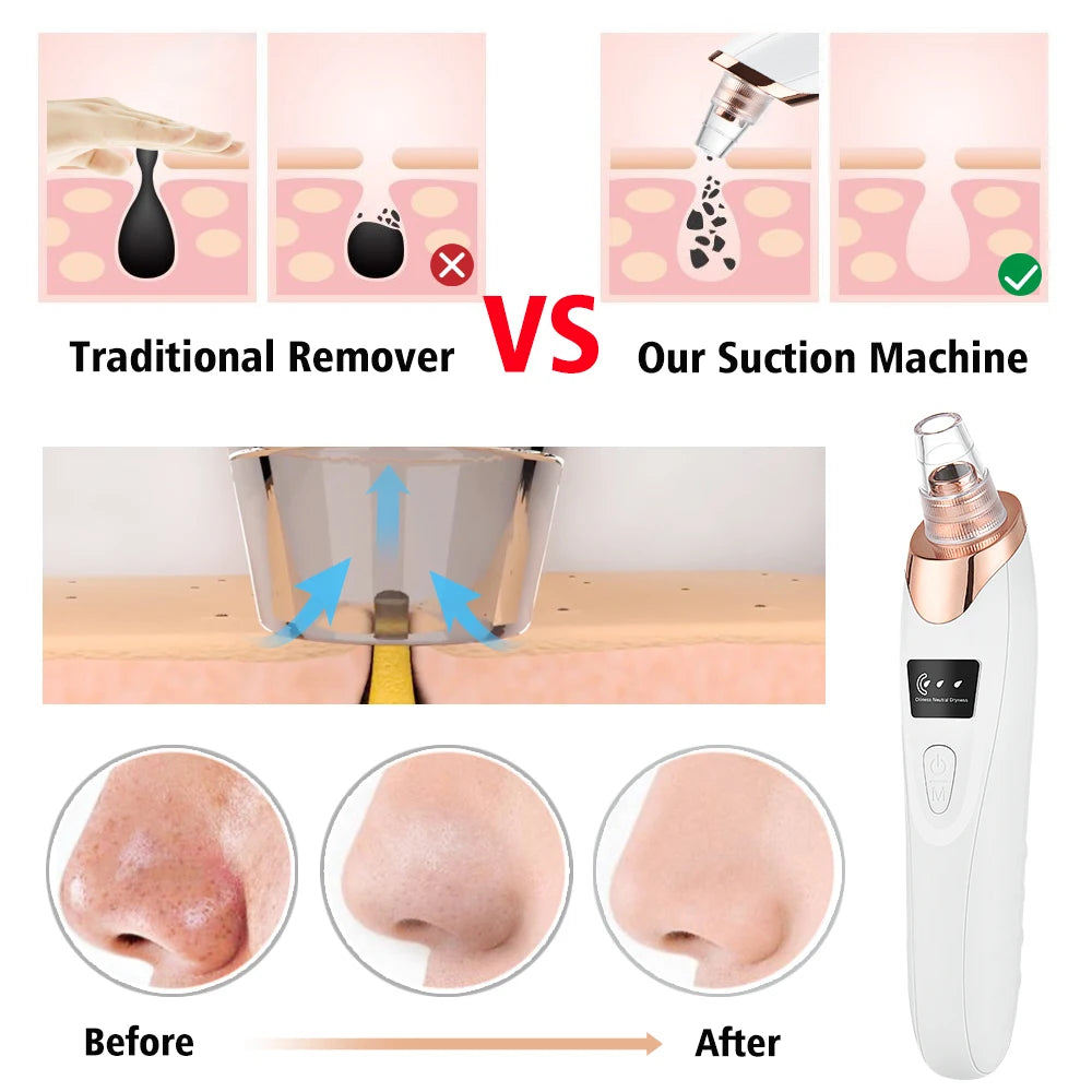 Deep Clean Blackhead Remover Vacuum Kit